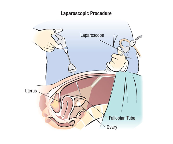 Laparoscopic Procedure